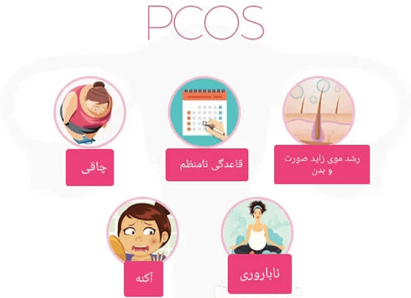 سندرم تخمدان پلی کیستیک