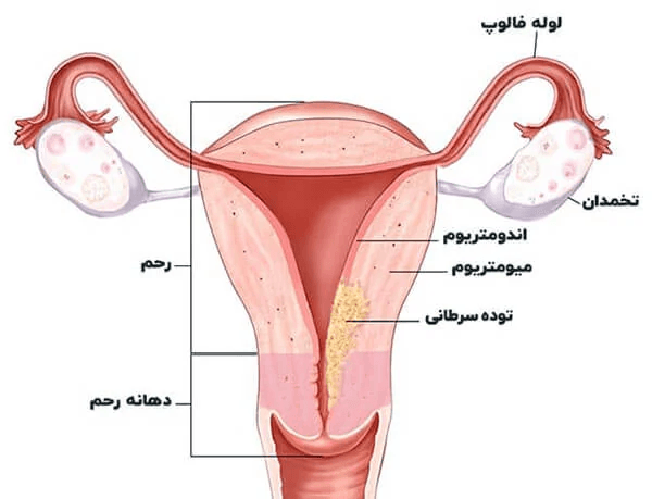 سرطان رحم، از علائم تا درمان