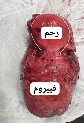 هیسترکتومی به دلیل فیبروم بخش تحتانی رحم که باعث اثر فشاری روی حالب و مثانه شده بود