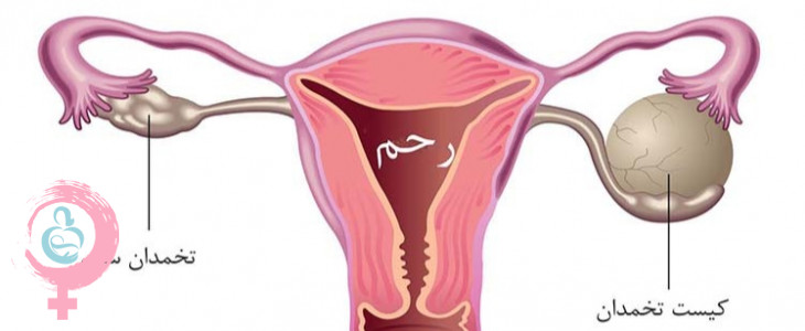 کیست تخمدان