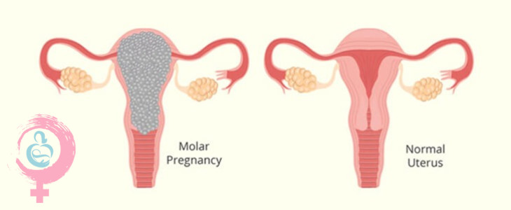 بارداری مول (مول هیداتیفرم) چیست؟