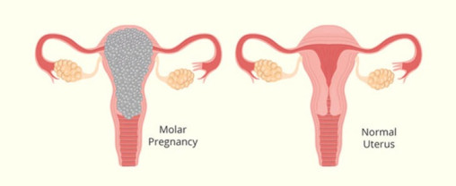بارداری مول (مول هیداتیفرم) چیست؟