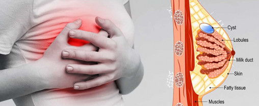 دردهای سینه در زنان و درمان آن
